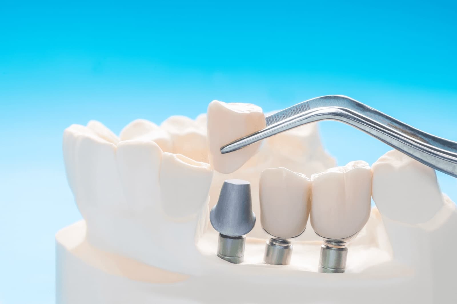 Prothèses sur implant — photo 2
